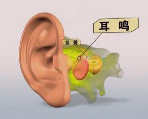 郑州民生医师讲中老年人耳鸣的原因