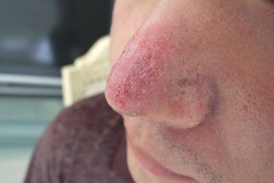 患有化脓性鼻窦炎怎么办，如何治?