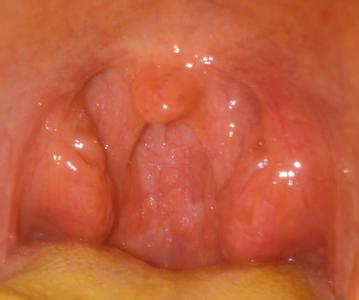 扁桃体肿大哪些症状,你有没有?